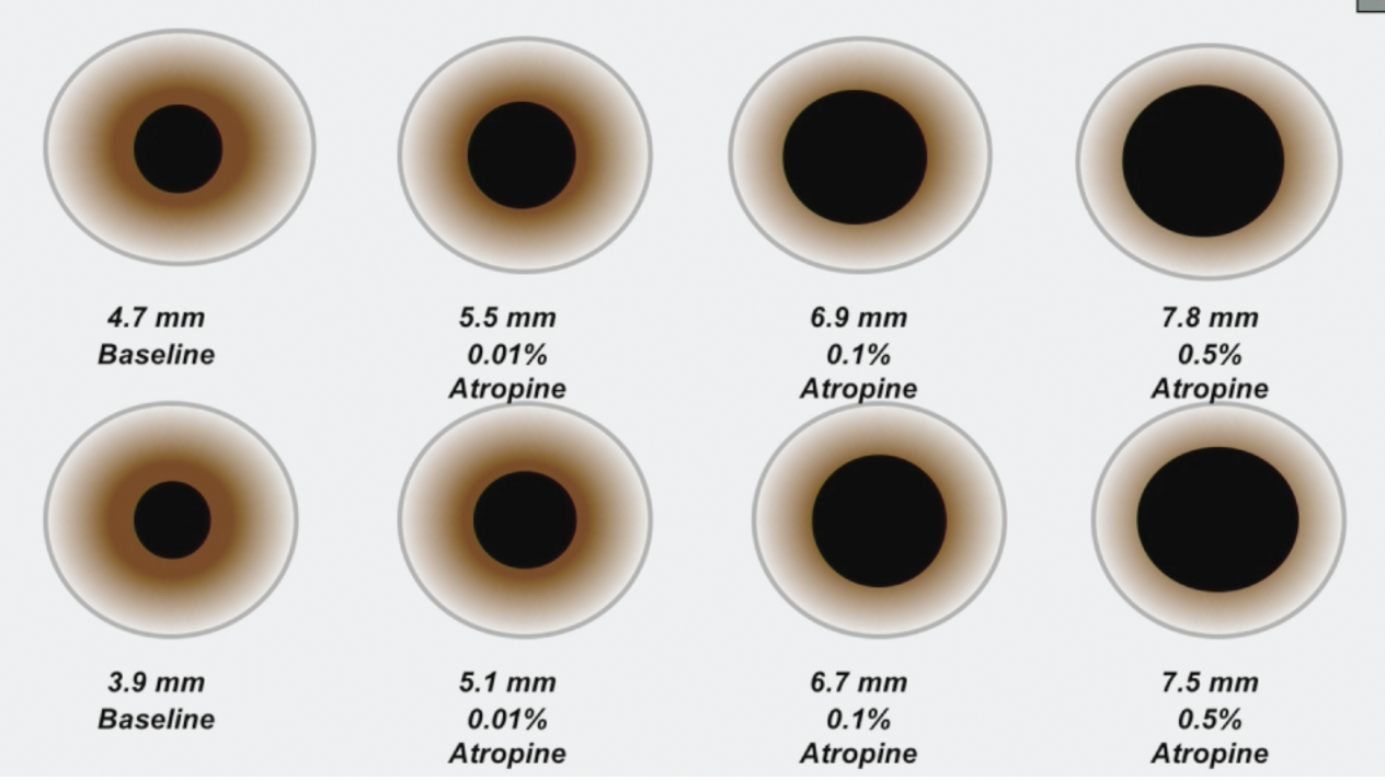 Many studies show atropine’s value in mitigating myopia progression, but optimal dosing to avoid adverse effects remains a point of contention. The ATOM2 study tested three concentrations: 0.01%, 0.1% and 0.5%. 