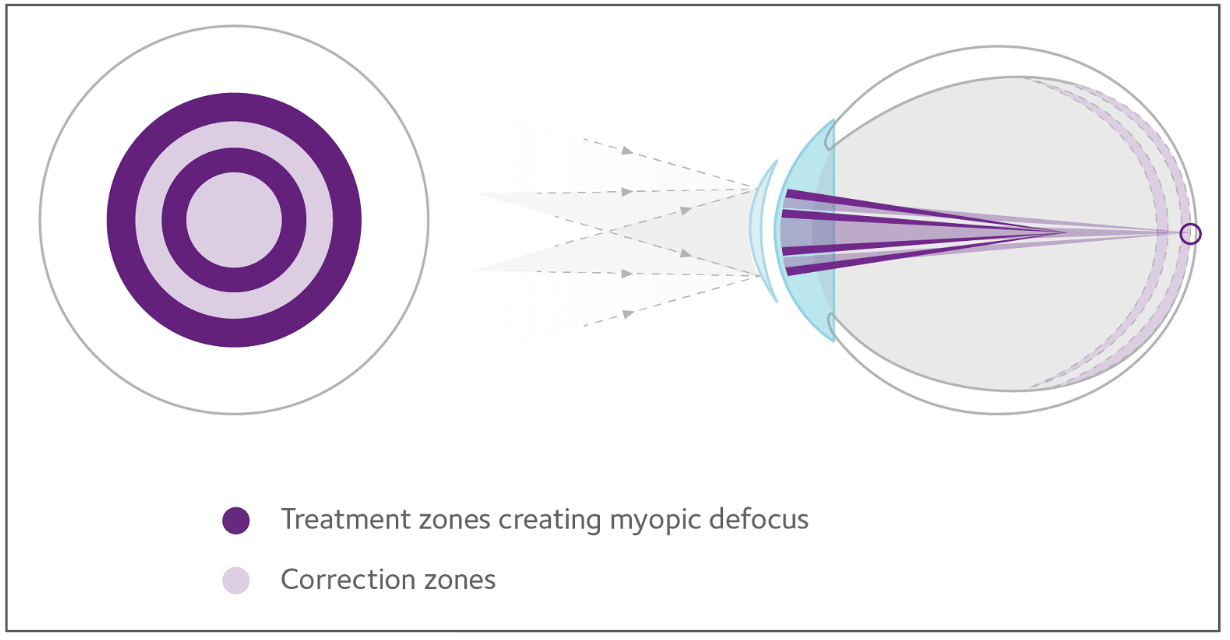 The MiSight lens can slow progression of axial elongation by 52% and refractive error increase by 59%, its pivotal trial found. 