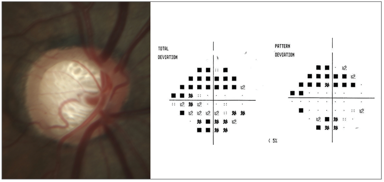 Do the findings of AGIS still guide us in the appropriate care of this 65-year-old patient of African descent with advanced disease? 