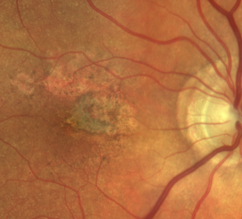 AREDS2 supplements can reduce risk of conversion from dry to wet AMD but the safety of zinc remains controversial. 