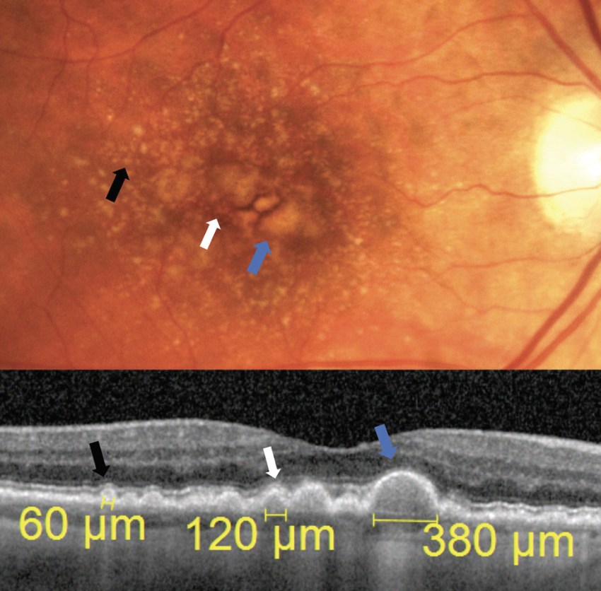 The Beaver Dam Eye Study brought increased attention to vigilance for AMD, including careful assessment of drusen.