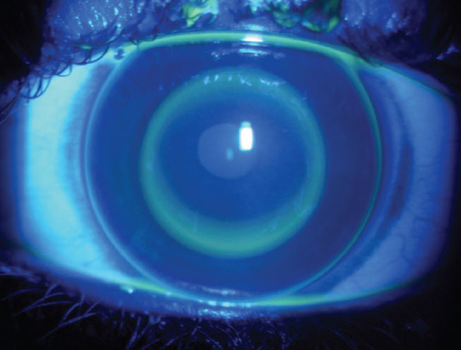 : If your targets are being met after one year of ortho-K, the modality is likely worth continuing; if results are suboptimal, consider a shift to different option or an addition of another modality to better control the progression of myopia, these researchers argue.