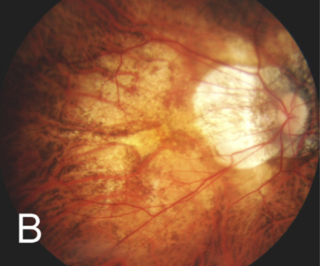 This study was the first to identify a single nucleotide polymorphism (rs56257842 at TEX29 - LINC02337) associated with myopic MNV in patients with high myopia, expanding our knowledge of the condition’s pathogenesis.