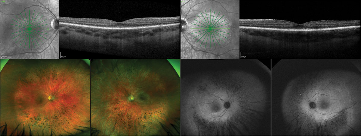 Despite experiencing structural decline over the course of 10 years, several participants in this study with both autosomal recessive and autosomal dominant rod-cone dystrophy also maintained stable visual function. This highlights the need to further examination of distinct patterns of decline within and between genetic subgroups. 