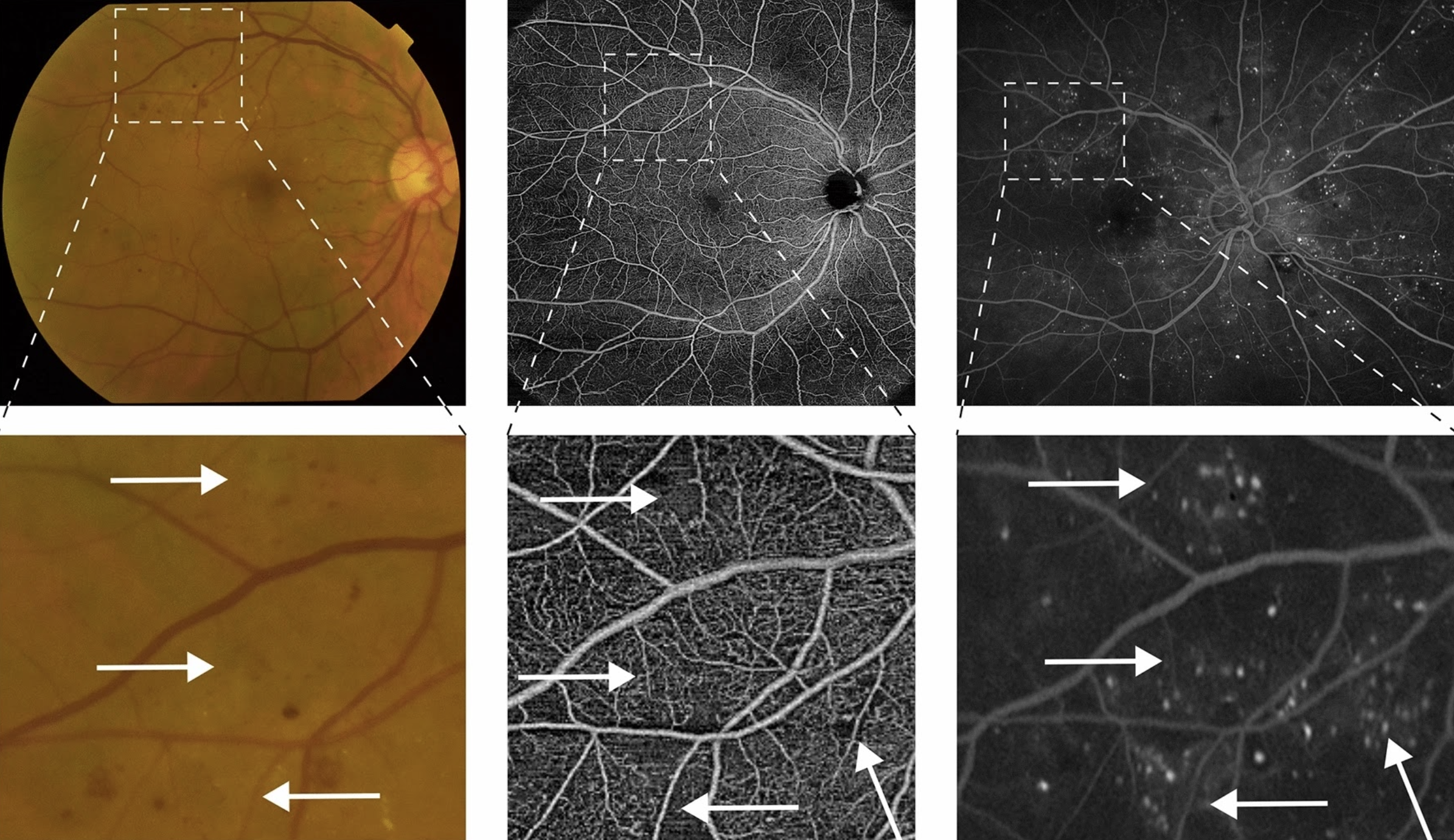 Development of IRMA appears to be associated with the hyperperfusion stage of non-proliferative DR and may be the hallmark of this angiogenic response to the progressive ischemia. This image from the paper shows identification of IRMA in the different modalities used (fundus photography, OCT-A and ultra-widefield fluorescein angiography). Images are shown with different magnifications to compensate for different field of view.