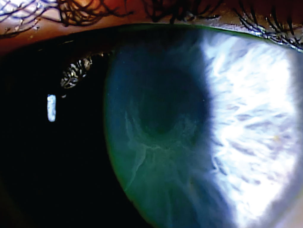 Vortex keratopathy is the most common drug-related alteration to the corneal epithelium, creating a whorl-like pattern.