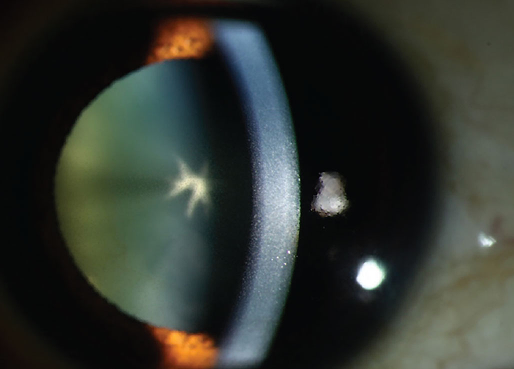 Chlorpromazine cataract and endothelial deposits. This drug causes deposition in the corneal stroma appearing as brown opacities.