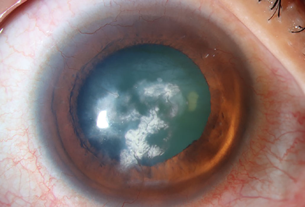 Lipid keratopathy occurs commonly from amphiphilic medications that can penetrate lysosomes in corneal cells and deposit lipids.