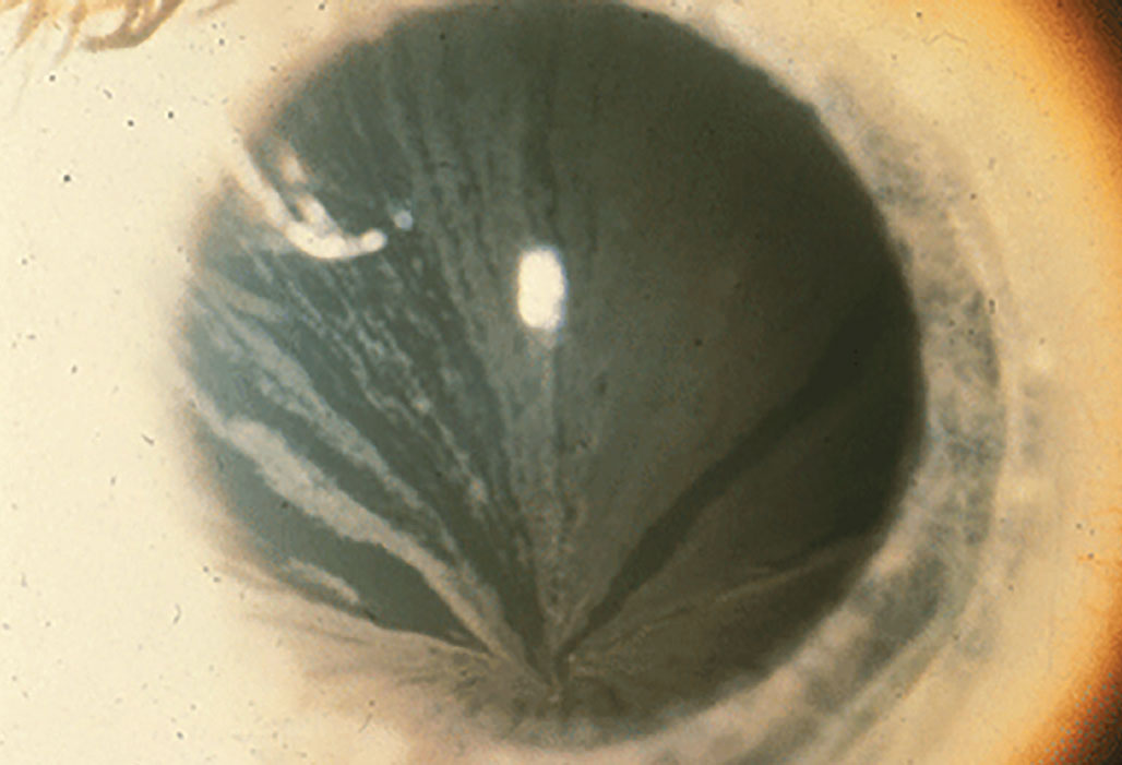 In Fabry disease, bilateral corneal diffuse yellow epithelial haziness eventually becomes dense bronze to cream-colored streaks arranged in a vortex or star-shaped pattern (whorl-like or verticillata).