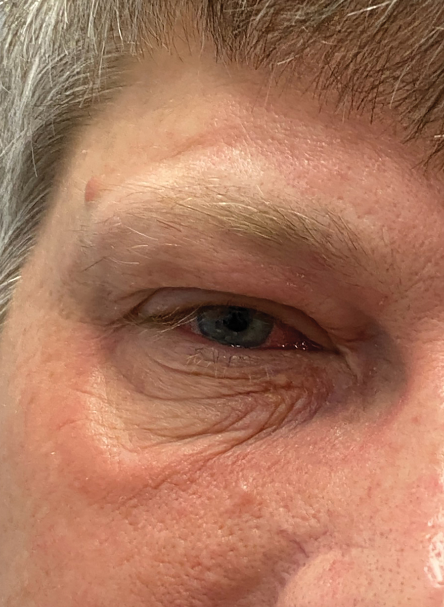 A patient with chronic styes presents with an associated preseptal cellulitis. 