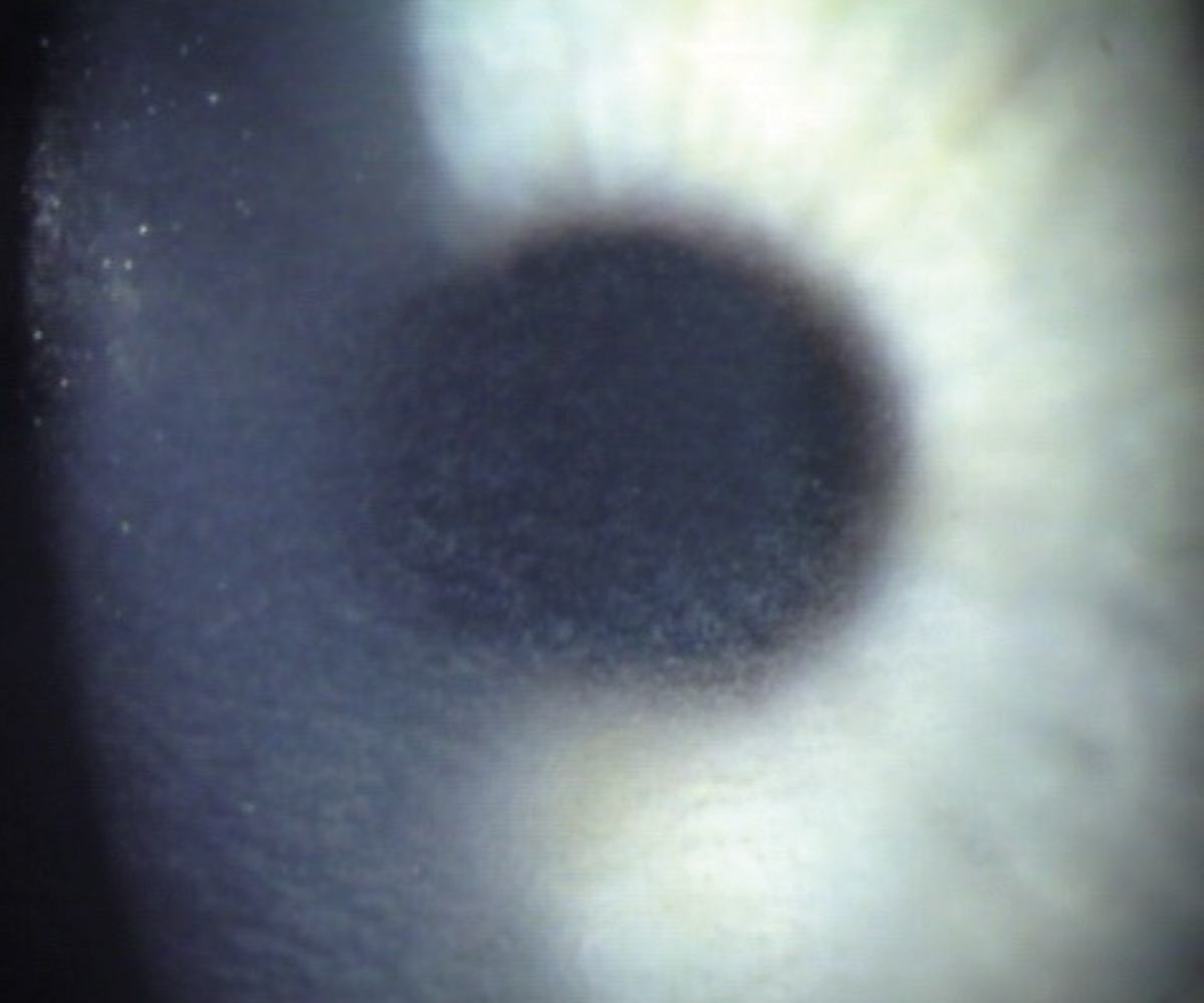 Grade 2 DLK reveals diffuse spreading of inflammatory cells over the entire cornea. In grade 1, the cells are limited to the peripheral cornea. This appearance was termed “sands of Sahara” in older literature.