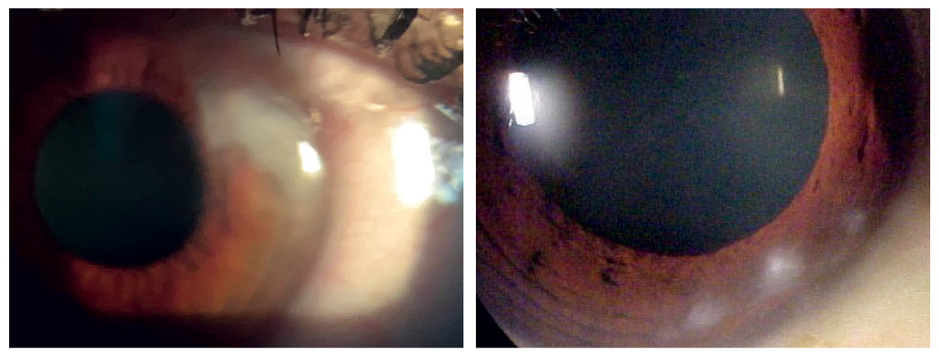 Slit lamp presentation of each eye showing subepithelial deposits.