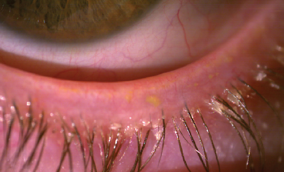 Fig 4. Collarettes at the eyelash base typical of Demodex blepharitis.