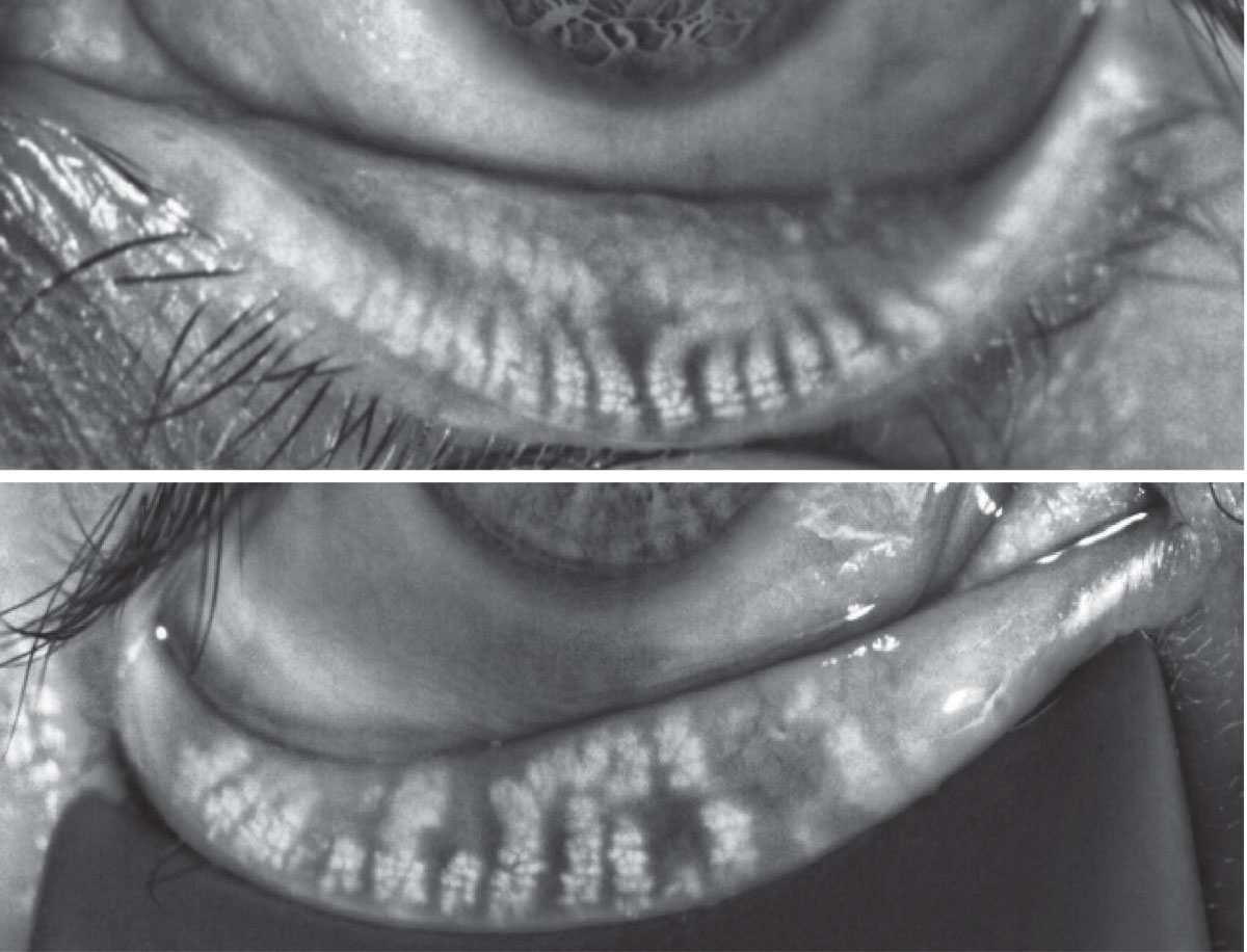 Fig. 4. Miebography images showing normal gland anatomy (top) vs. a presentation characterized by gland dilation and atrophy (bottom).