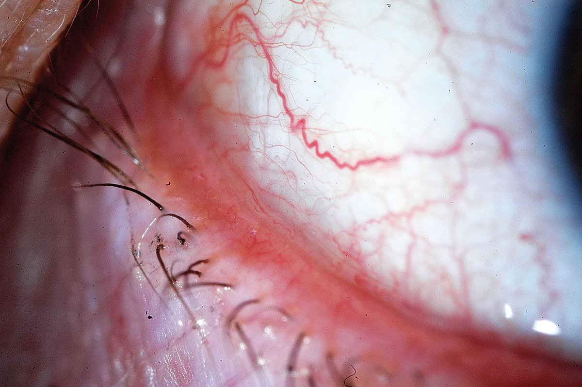 Fig. 5. Depending on the severity of conjunctivochalasis, treatment options consist of lubricating drops, topical corticosteroids, antihistamines and even surgery when warranted.