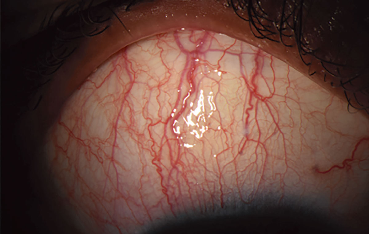 Fig. 6. Most patients with SLK present with symptoms of foreign body sensation and burning.