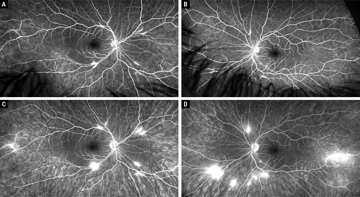 Fig. 3. Widefield Optos fluorescein angiogram early (A and B) and late phases (C and D) of both eyes at 10-month follow-up.