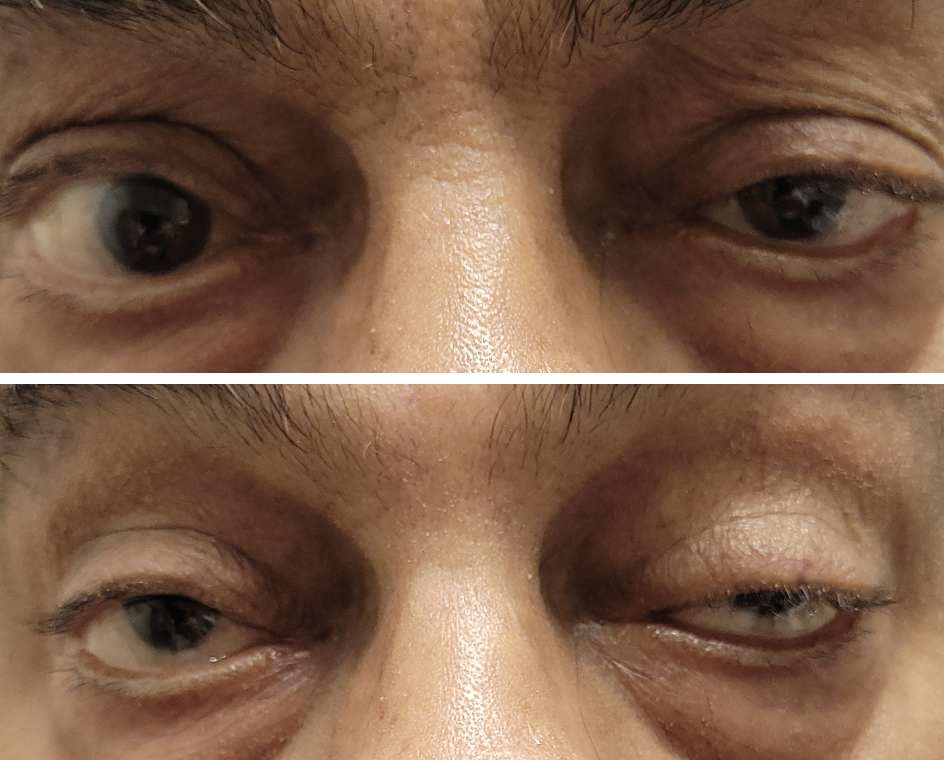 Sustained upgaze can help diagnose MG.