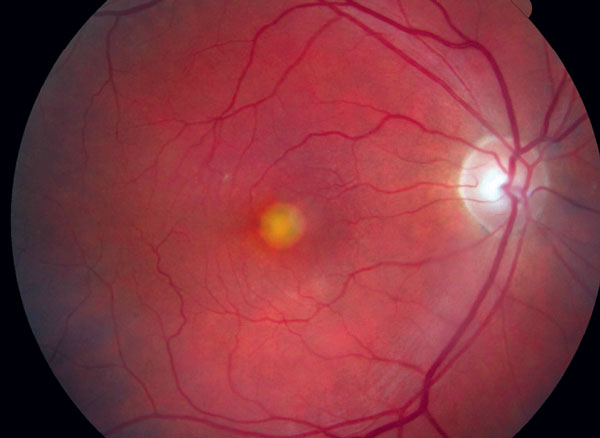 retinal detachment optomap