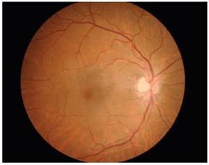 movist retina